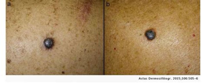 Are melanomas flat or raised?