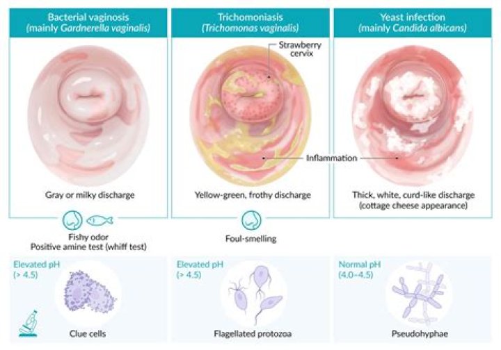 Can BV be mistaken for trichomoniasis?