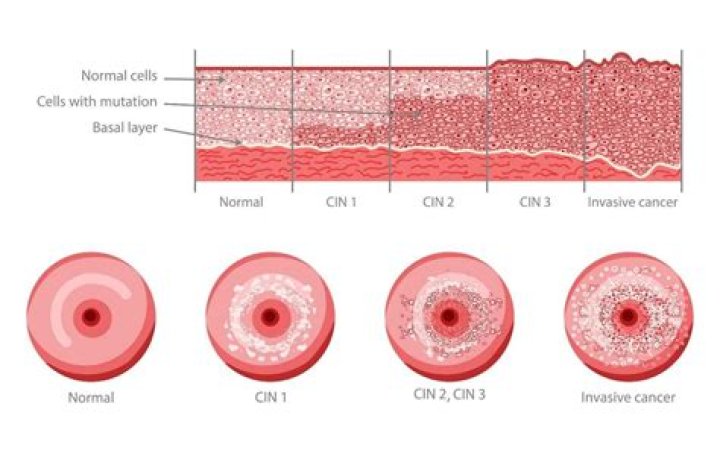 Can HPV recur years later?