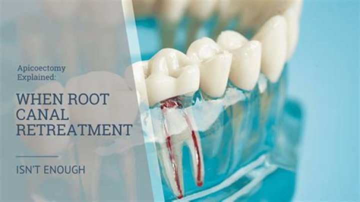 Can you retreat a root canal more than once?