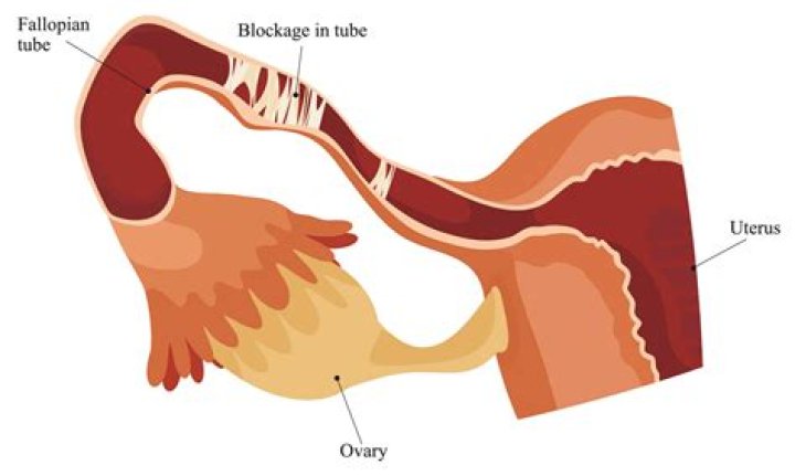 Can you still ovulate if your fallopian tubes are blocked?