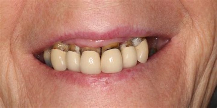 Do permanent dentures look natural?