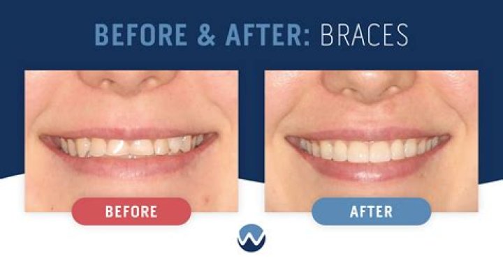 Do straight teeth make you look better?