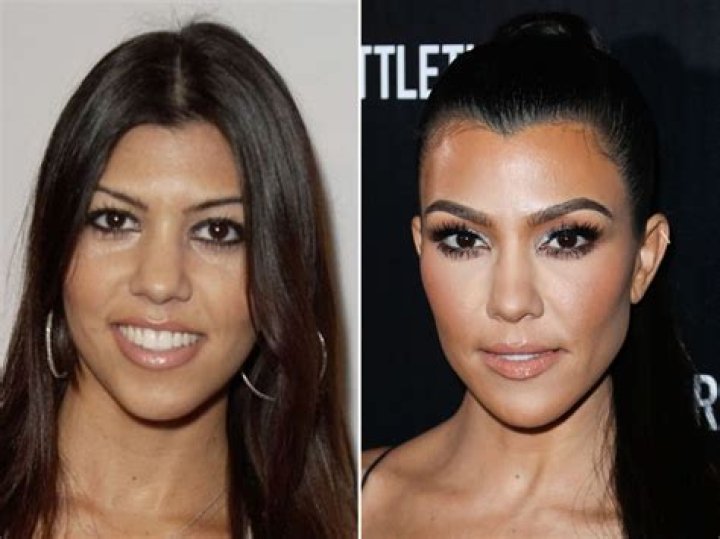 Do the Kardashians use Botox?