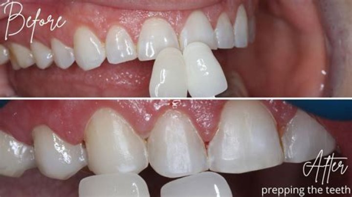 Do they shave your teeth for composite veneers?
