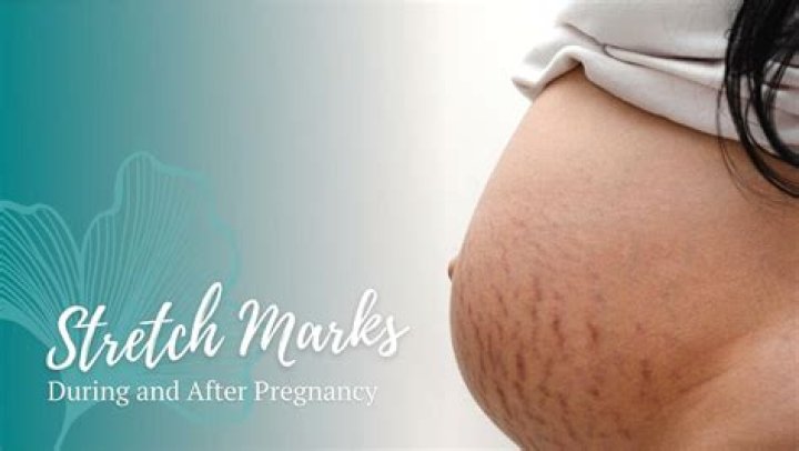 Do you get more stretch marks after birth?