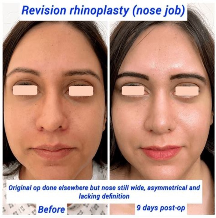 Does a woman's nose keep growing?