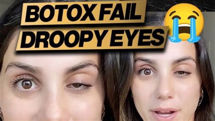 Does Botox look weird after?