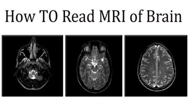 Does brain MRI show TMJ?