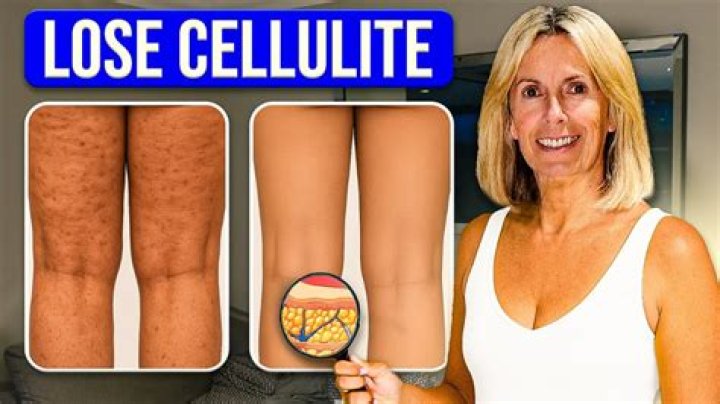 Does cheese give you cellulite?
