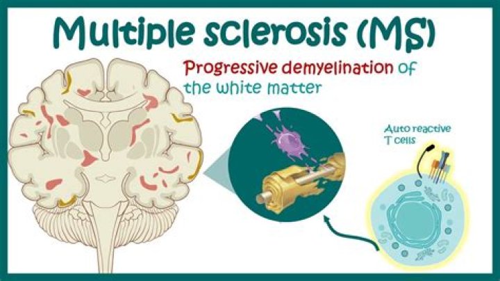 Does everyone with MS have lesions on the brain?