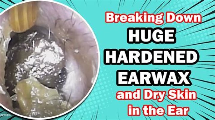 Does hardened ear wax hurt?