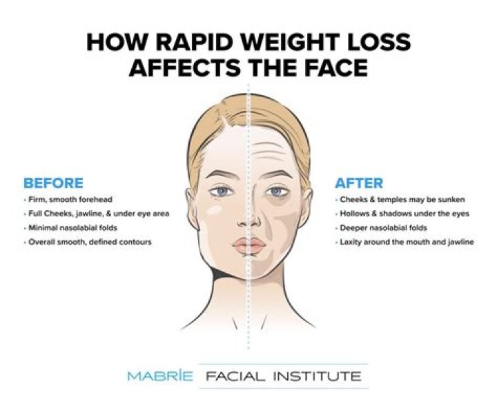 Does losing weight age your face?