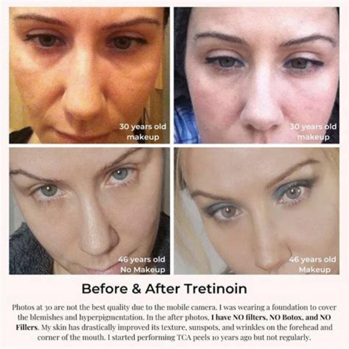 Does retinol help Crepey neck?