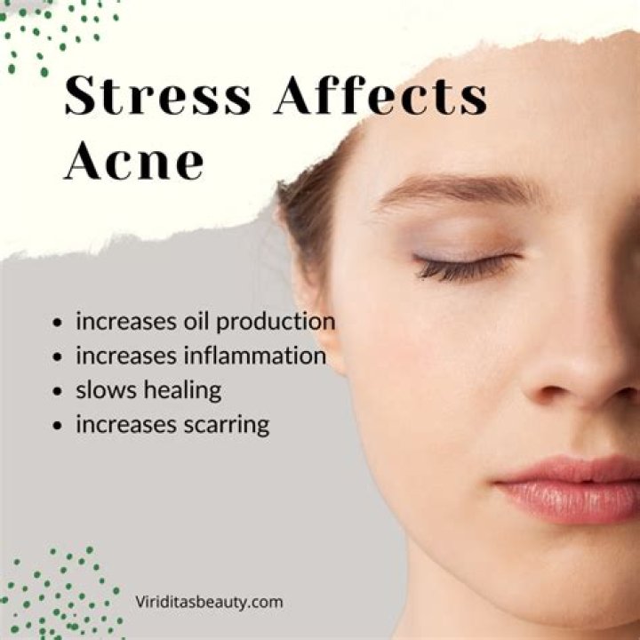 Does stress cause acne?