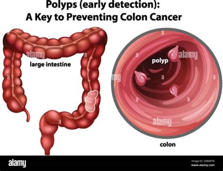 Does the size of a polyp indicate cancer?
