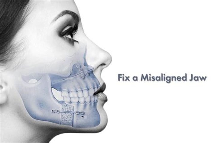 How can I fix my misaligned jaw naturally?