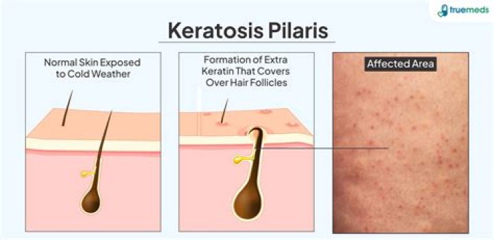 How can I get rid of my keratosis at home?
