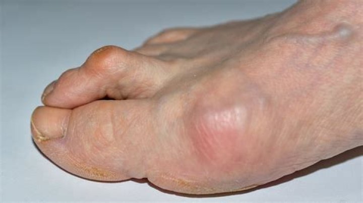 How can I straighten my hammer toes naturally?