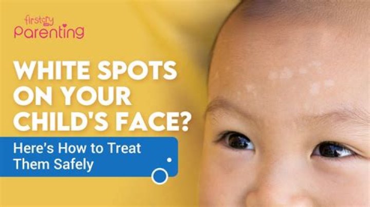 How can I treat white spots on my face?