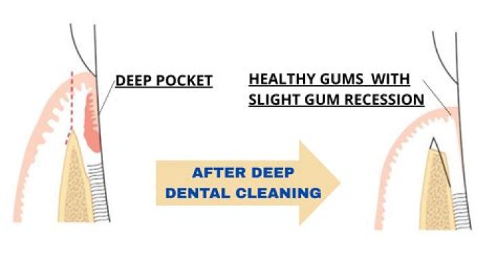 How do you clean deep gum pockets?