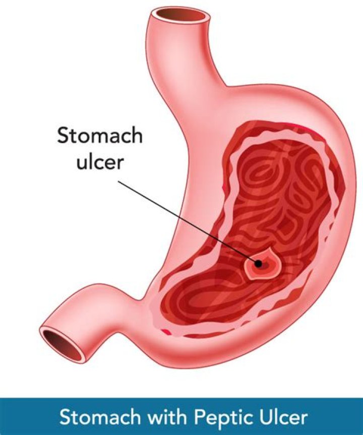 How do you get a perforated ulcer?
