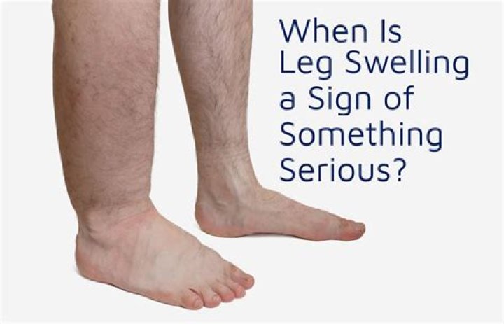 How do you know if swelling is serious?