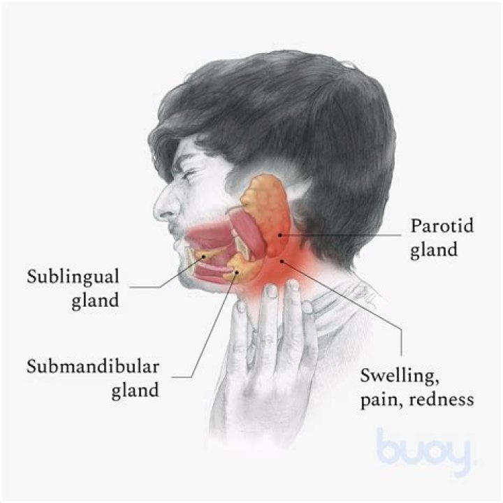How do you treat swollen glands in Sjogren's?