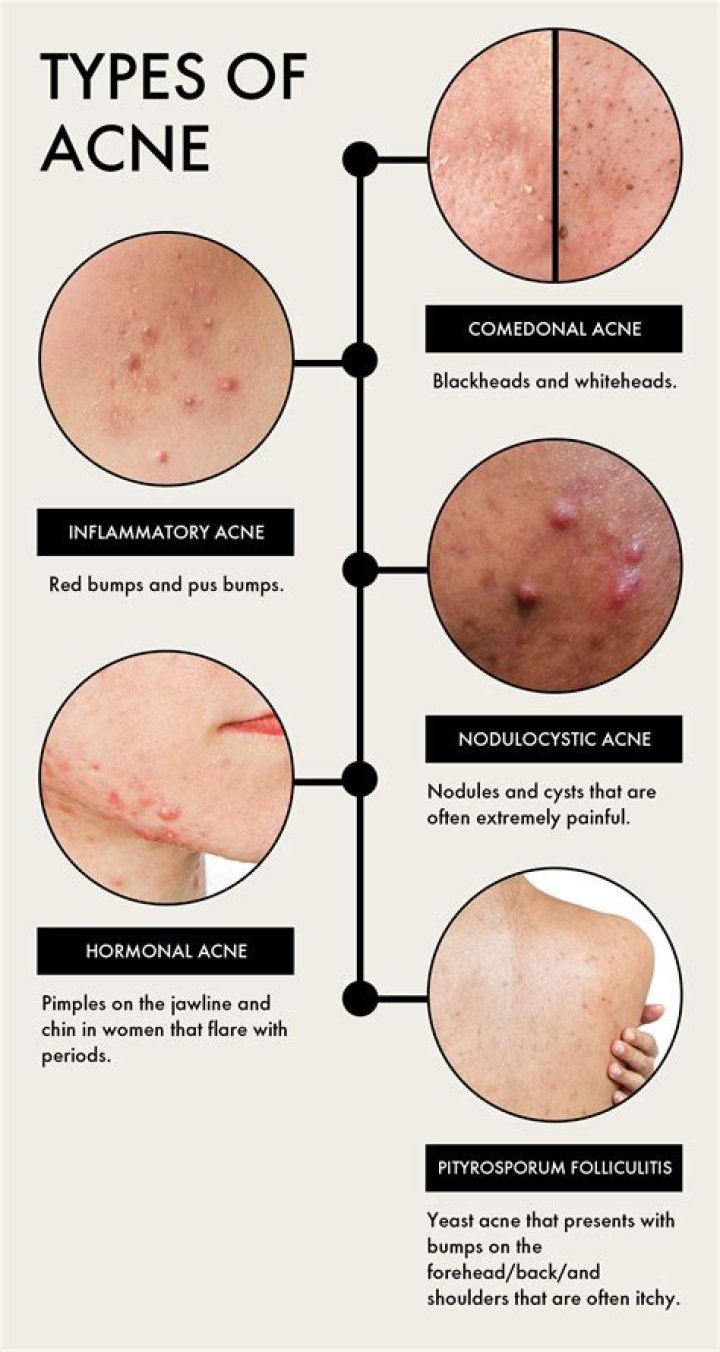 How does an acne look like?