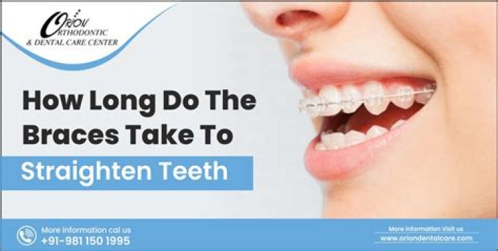 How long do braces take to straighten teeth?