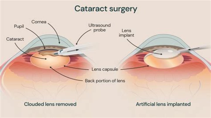 How long does it take for cataracts to make you blind?