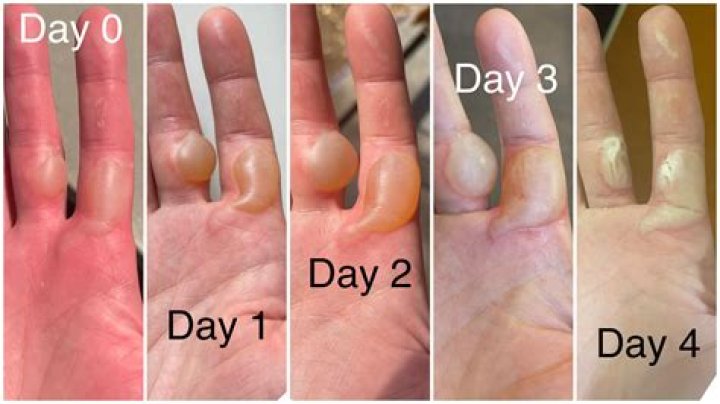 How long does it take for nerve damage in hand to heal?