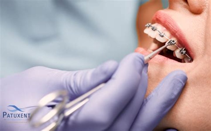 How much does braces removal cost?