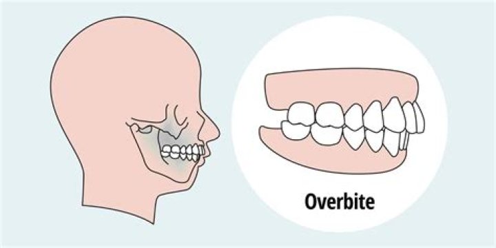 How much does it cost to fix an overbite?
