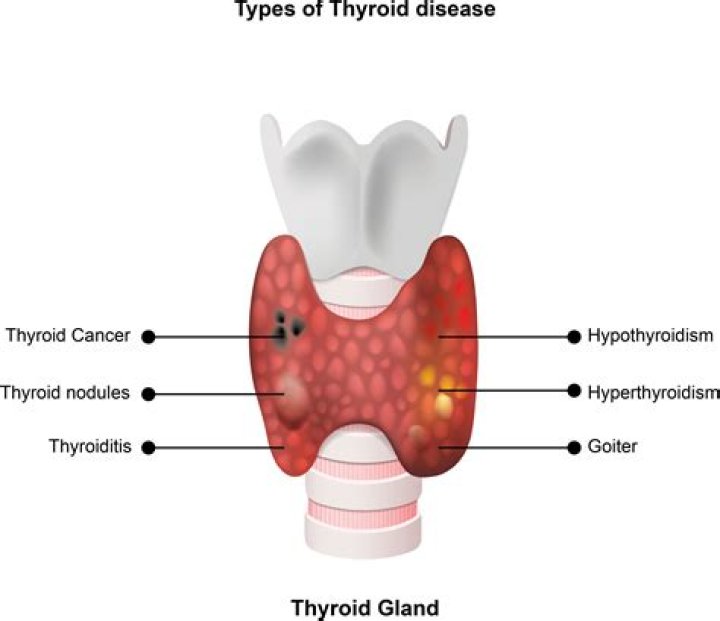 Is cheese good for thyroid?