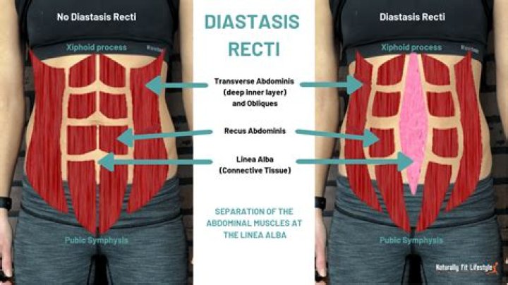 Is diastasis recti hard or soft?