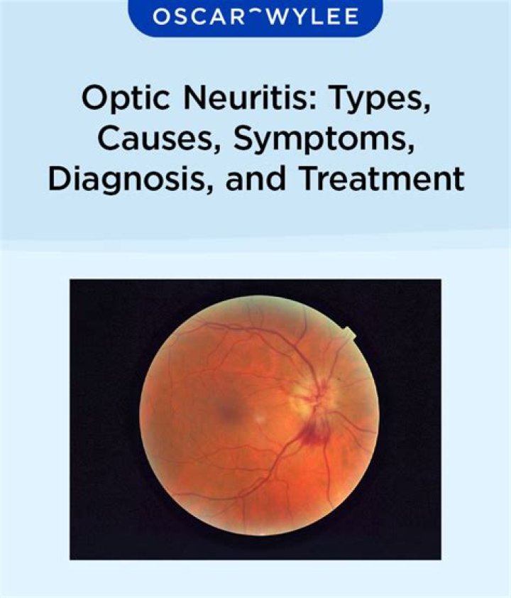 Is there a blood test for optic neuritis?