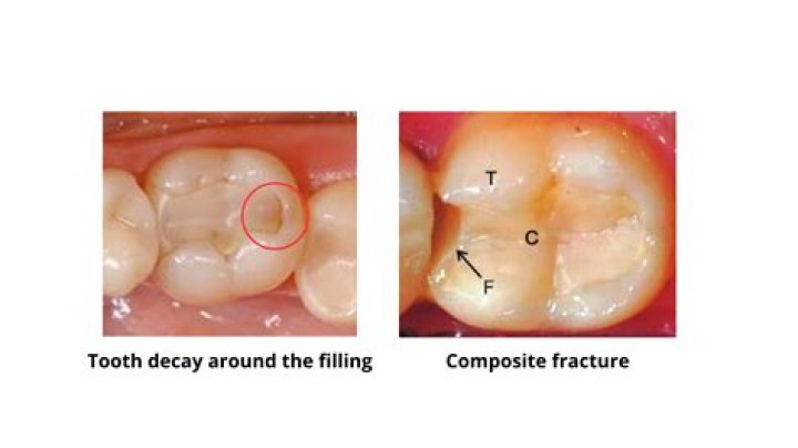 Is tooth filling poisonous?