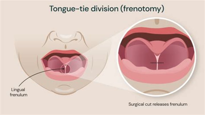 Should tongue-tie be cut?