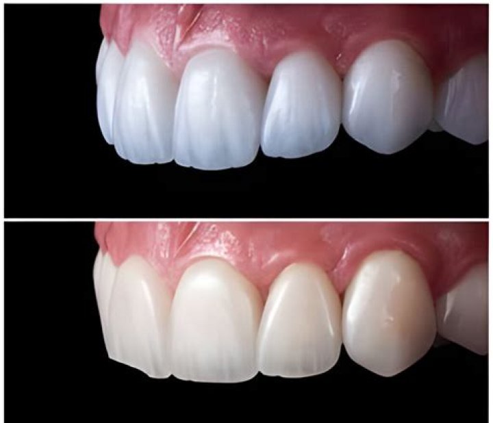 What's better veneers or crowns?