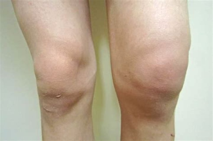 What does prepatellar bursitis look like?