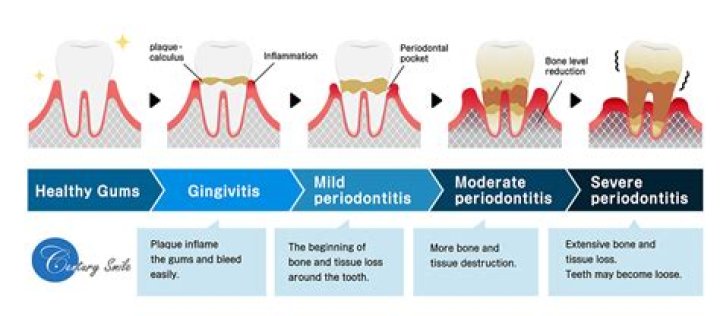 What happens if you don't treat periodontitis?