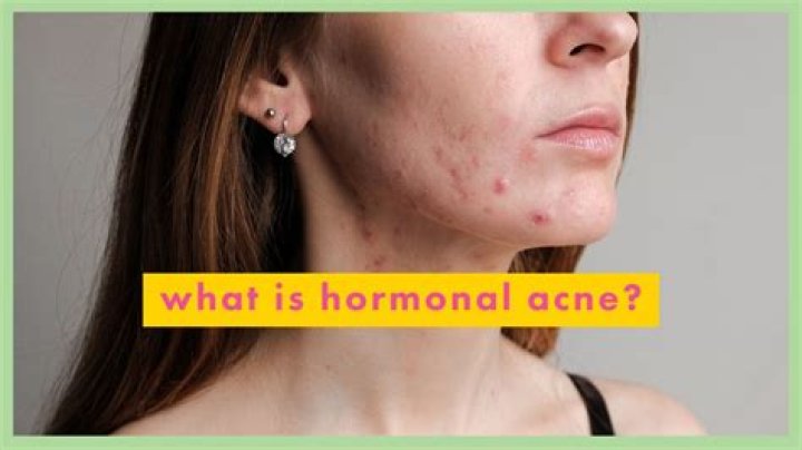 What hormone causes cystic acne?