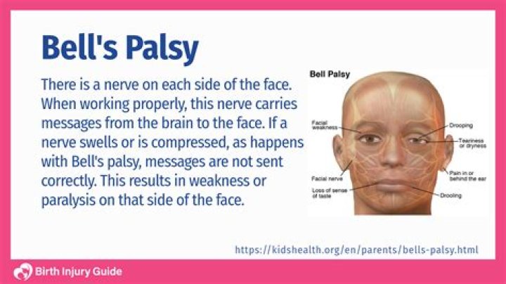 What if Bell's palsy doesn't go away?