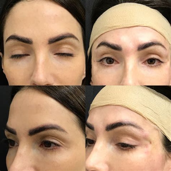 What is a cat eye lift?