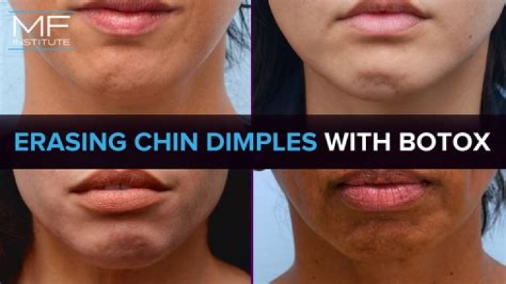 What is chin dimpling?