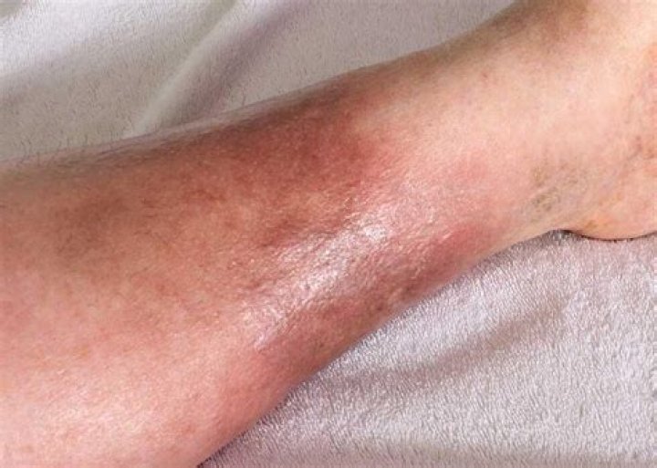 What is good for cellulitis on legs?
