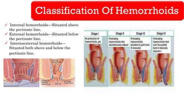 What is inside a hemorrhoid?