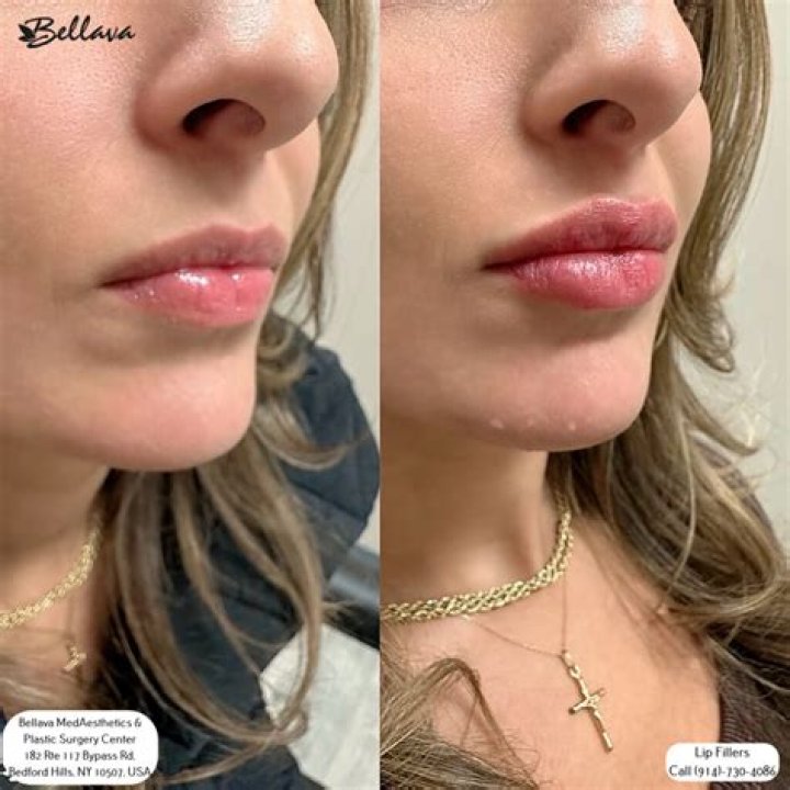 What is the longest lasting lip filler?