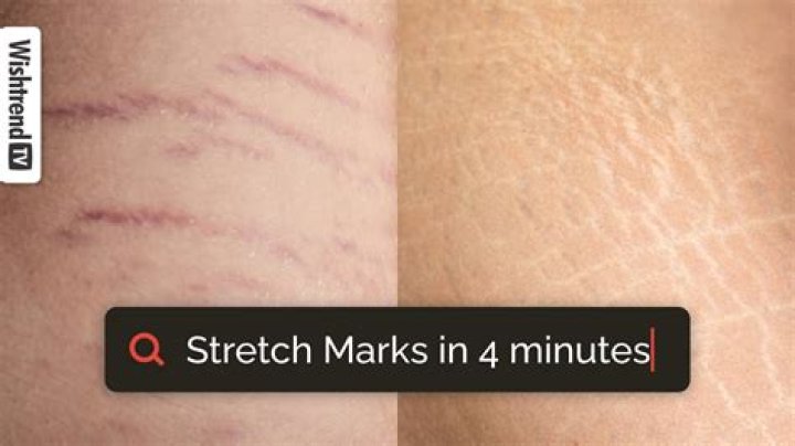 Why am I skinny with stretch marks?